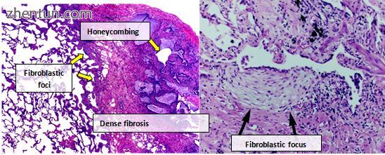 Photomicrograph of the histopathological appearances of usual.jpg