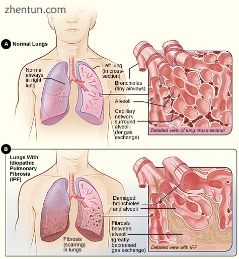 Idiopathic pulmonary fibrosis.jpg