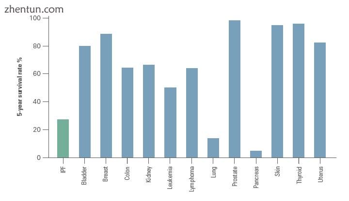 Comparison of the 5-year survival rate for IPF and common malignancies. Adapted .jpg