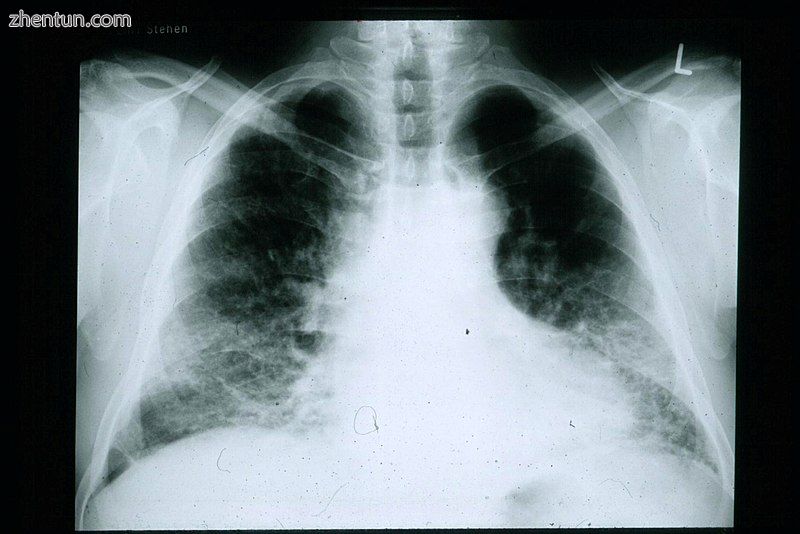 A chest radiograph of a patient with IPF. Note the small lung fields and periphe.jpg