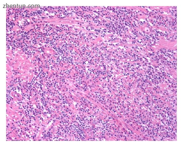 Low power view of IgG4-related prostatitis. The prostatic stroma shows a dense i.jpg