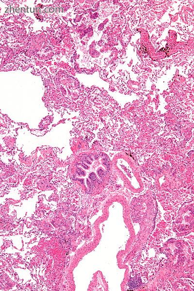 Micrograph of lymphangioleiomyomatosis. H&amp;E stain..jpg