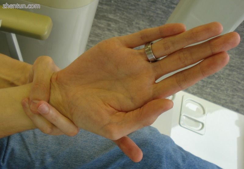 A positive wrist sign in a person with Marfan syndrome (the thumb and little fin.jpg