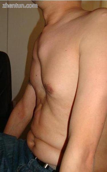 An anterior chest wall deformity, pectus excavatum, in a person with Marfan syndrome.jpg