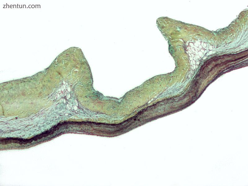 Micrograph demonstrating myxomatous degeneration of the aortic valve, a common m.jpg