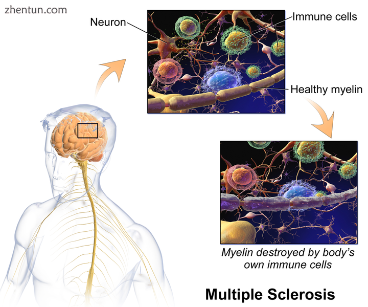 Multiple sclerosis.png