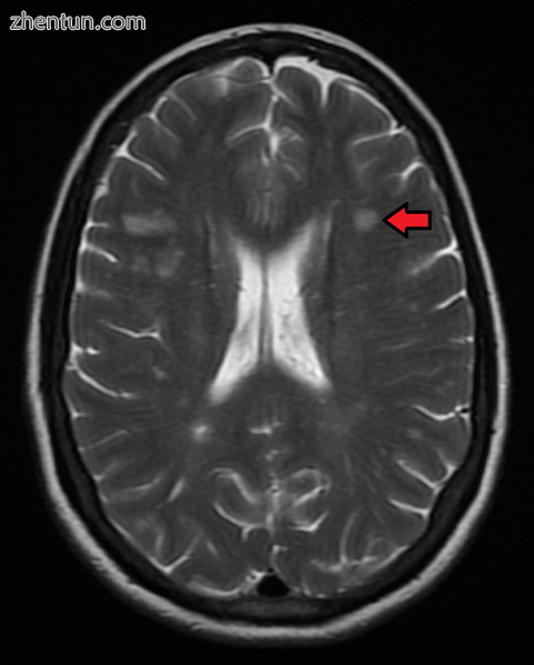 Multiple sclerosis as seen on MRI.png