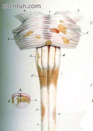 Detail of Carswell&#039;s drawing of MS lesions in the brain stem and spinal cor.jpg