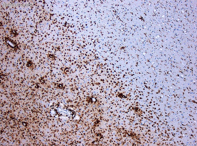 Demyelination by MS. The CD68 colored tissue shows several macrophages in the ar.jpg
