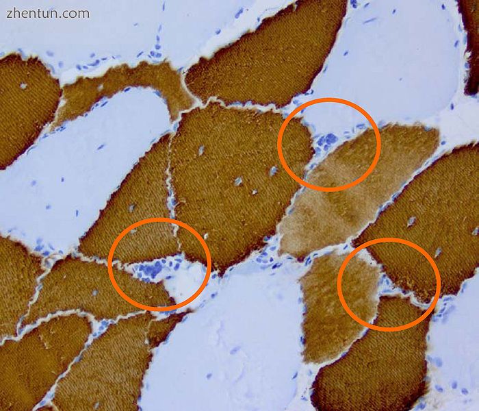 Histopathology of DM2. Muscle biopsy showing mild myopathic changes and.jpg