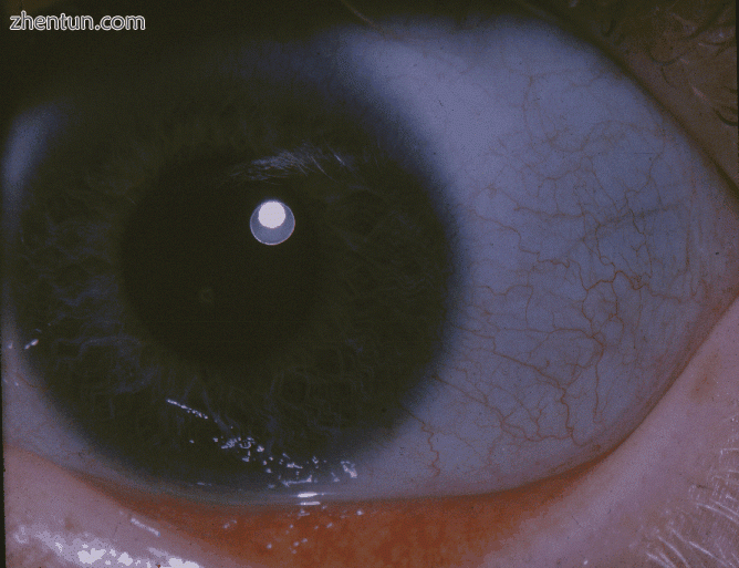 Blue sclera in osteogenesis imperfecta.gif