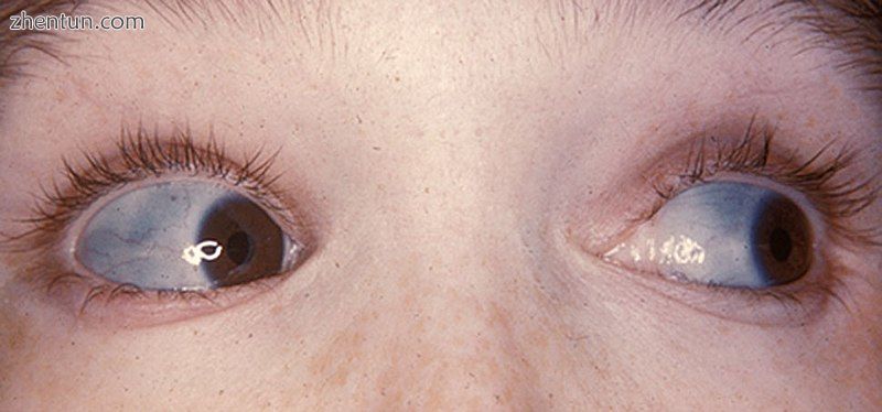 The classic blue sclerae of a person with osteogenesis imperfecta.jpg