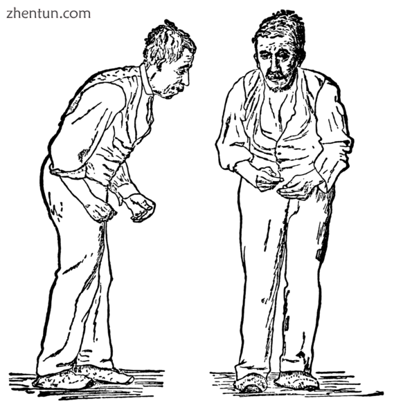 Illustration of Parkinson&#039;s disease by William Richard Gowers, first publis.png