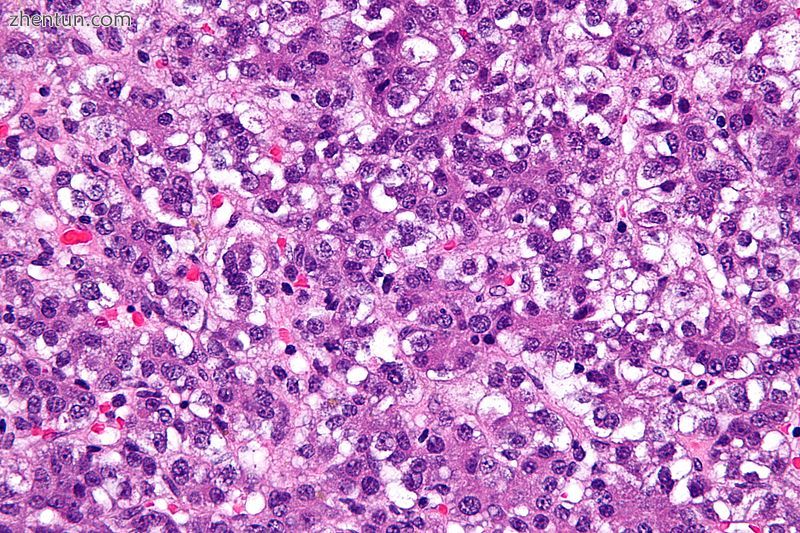 Micrograph of a hepatoblastoma. H&amp;E stain..jpg