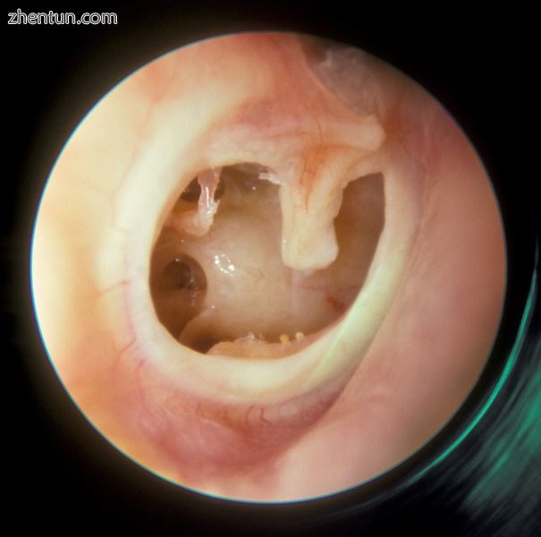 Perforation of the right tympanic membrane resulting from a previous severe acut.jpg