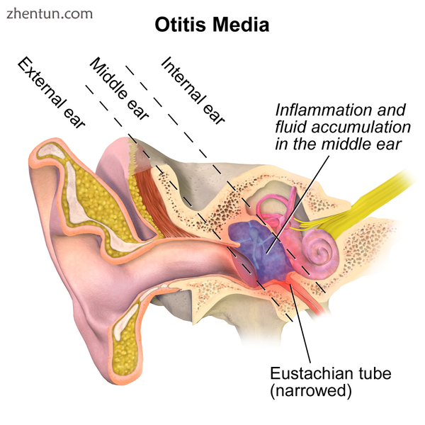 Otitis media..png