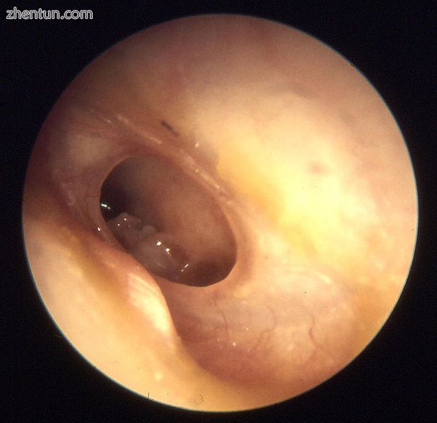 Otitis media chronica mesotympanalis2.jpg