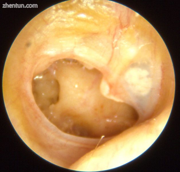 Otitis media chronica mesotympanalis.jpg