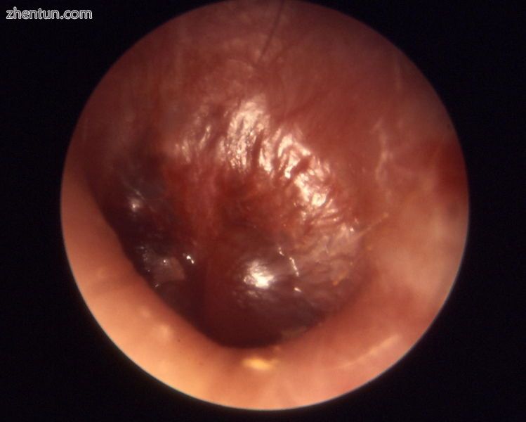 Myringitis bullosa in influenza.jpg