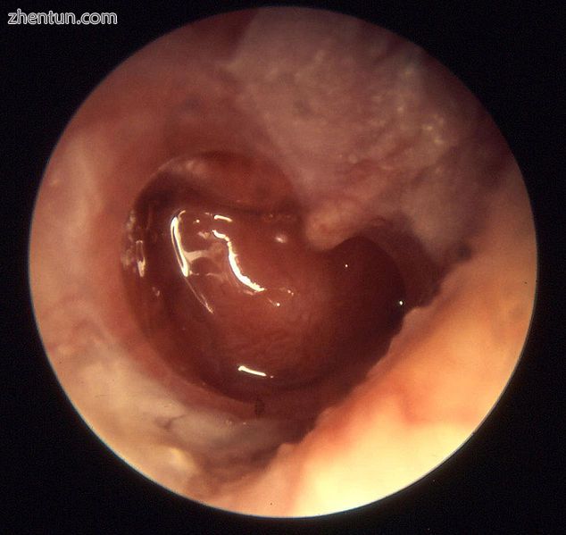 Chronic otitis media (otitis media chronica mesotympanalis).jpg