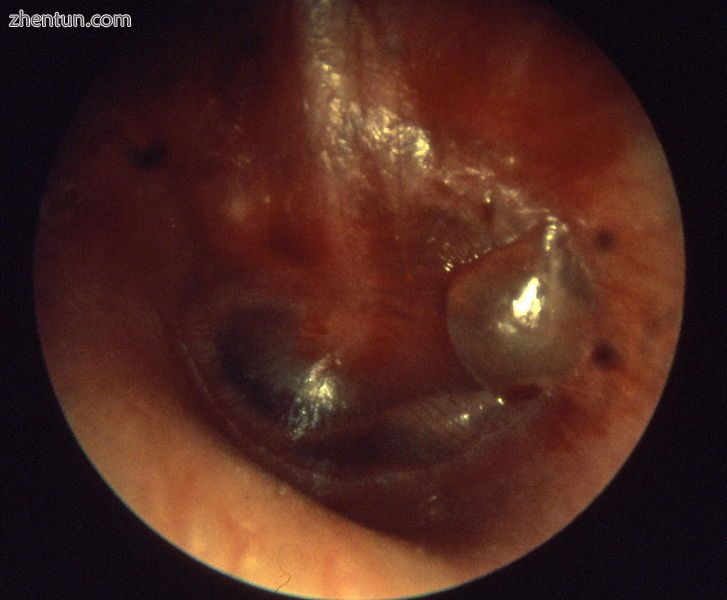 Acute otitis media, myringitis bullosa.jpg