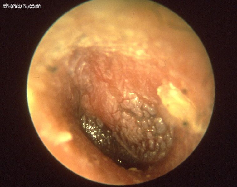 Acute otitis media.jpg