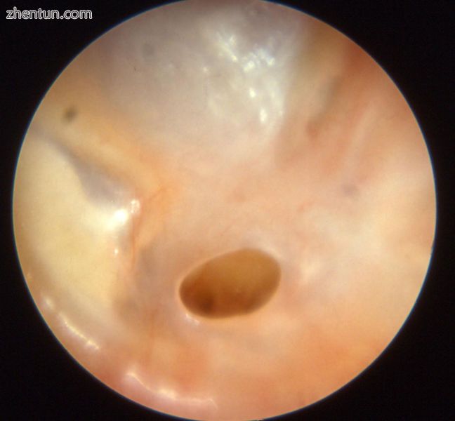 Otitis media chronica mesotympanalis1.jpg