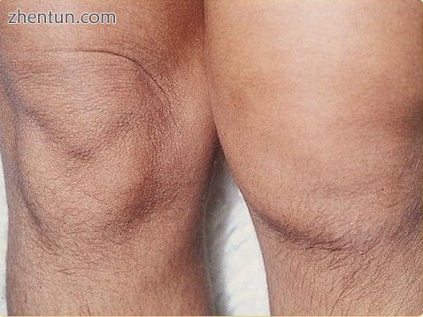 Reactive arthritis of the knee.jpg