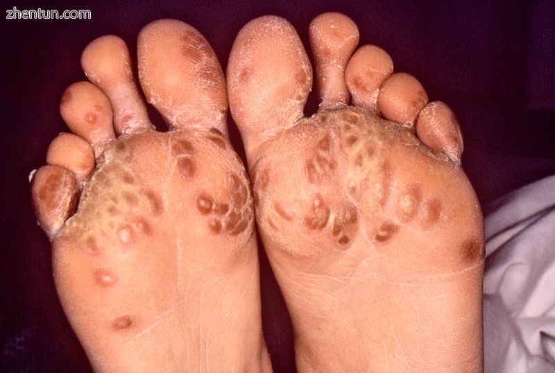 Keratoderma blennorrhagicum due to reactive arthritis.jpg