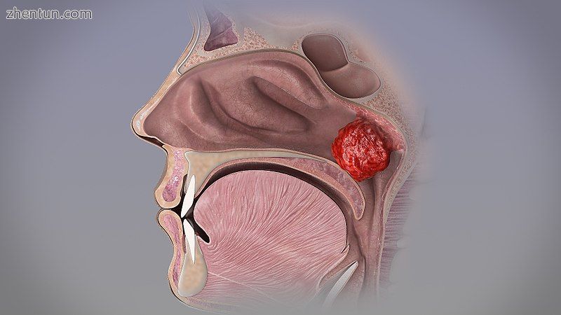 Ball-sized adenoid blocking the nasal passage..jpg