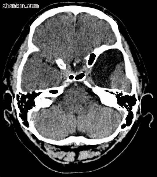 Axial CT showing a typical arachnoid cyst left temporal.jpg