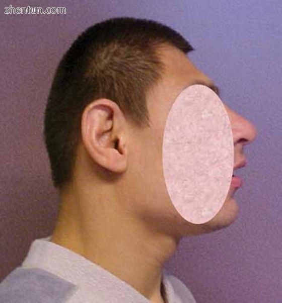 Abnormally small head (microcephaly).jpg