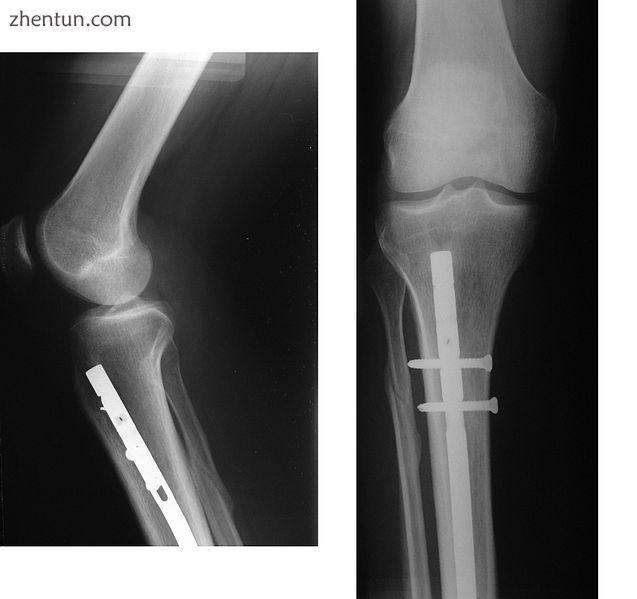 X-ray showing the proximal portion of a fractured tibia with an intramedullary nail.jpg