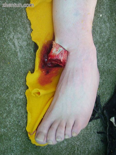 Open ankle fracture with luxation.jpg