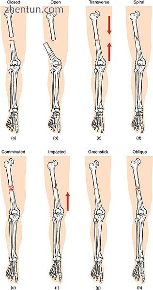 Compare healthy bone with different types of fractures.jpg