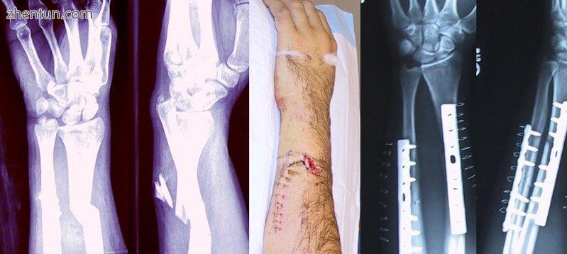 Internal and external views of an arm with a compound fracture, both before and .jpg