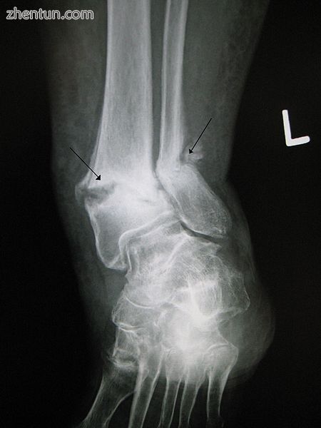 An old fracture with nonunion of the fracture fragments.JPG
