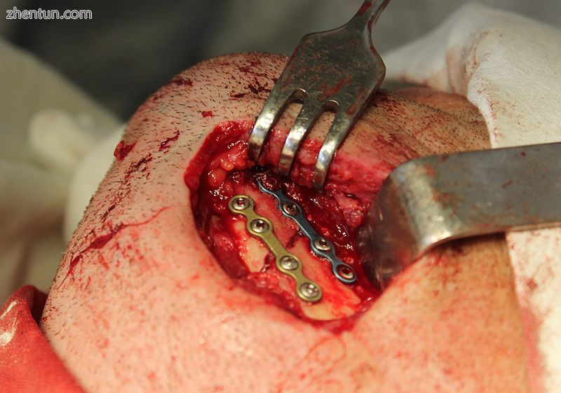The surgical treatment of mandibular angle fracture.jpg