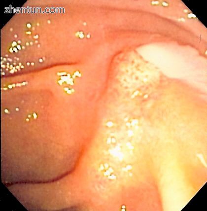 Duodenoscopy image of pus extruding from Ampulla of Vater, indicative of cholangitis.jpg
