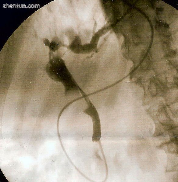 Cholangiogram through a nasobiliary drain showing the common bile duct in black .jpg