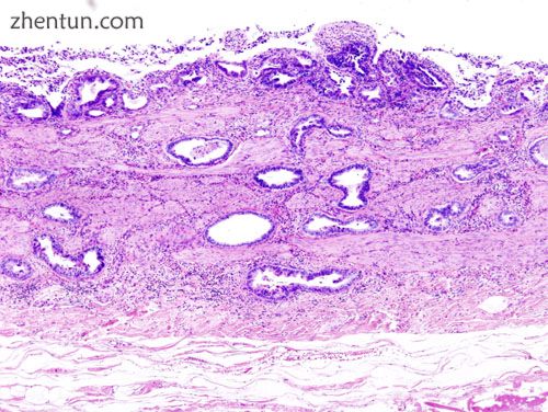 Incidentally discovered gallbladder cancer (adenocarcinoma) following a cholecys.jpg