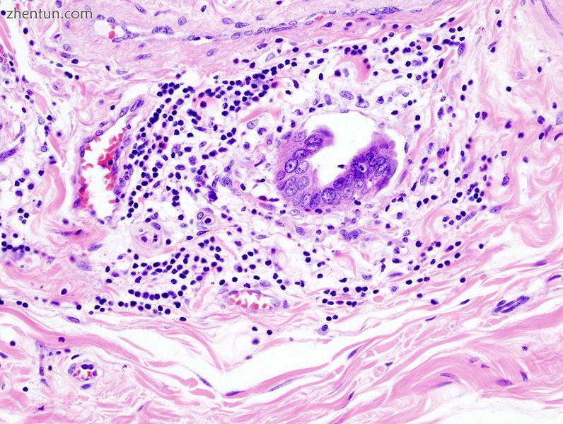 Gallbladder adenocarcinoma lymphatic invasion histopathology.jpg