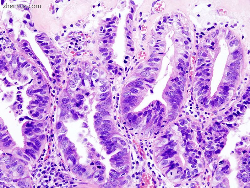 Gallbladder adenocarcinoma histopathology.jpg