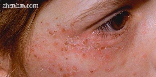 A skin rash in a person with porphyria.jpg