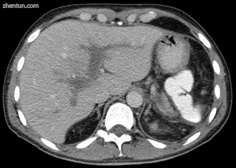 Portal vein thrombosis seen with computed tomography..png