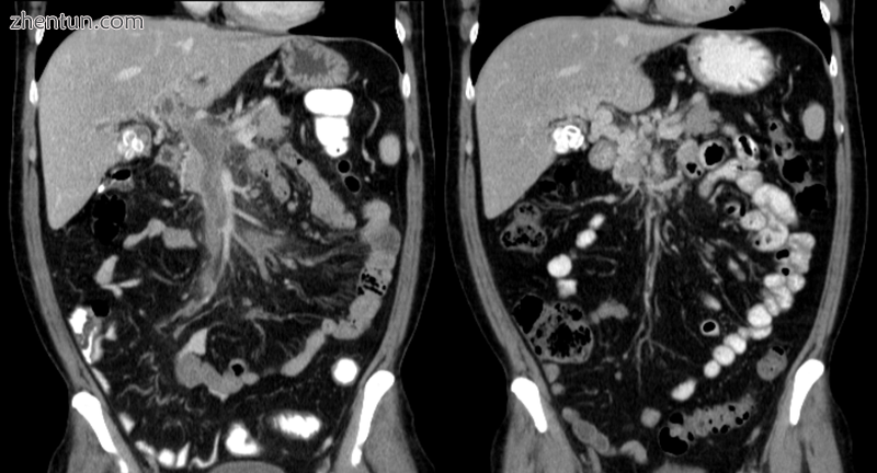 Portal vein thrombosis on computed tomography (left) and cavernous transformatio.png