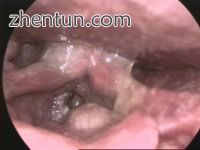 Larynx cancer - endoscopic view.jpg