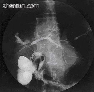 Cholangiogram of primary sclerosing cholangitis..jpg