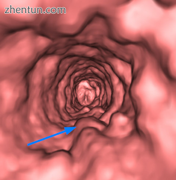 Volumetric CT rendering of multiple tracheal papilloma (arrow)..png