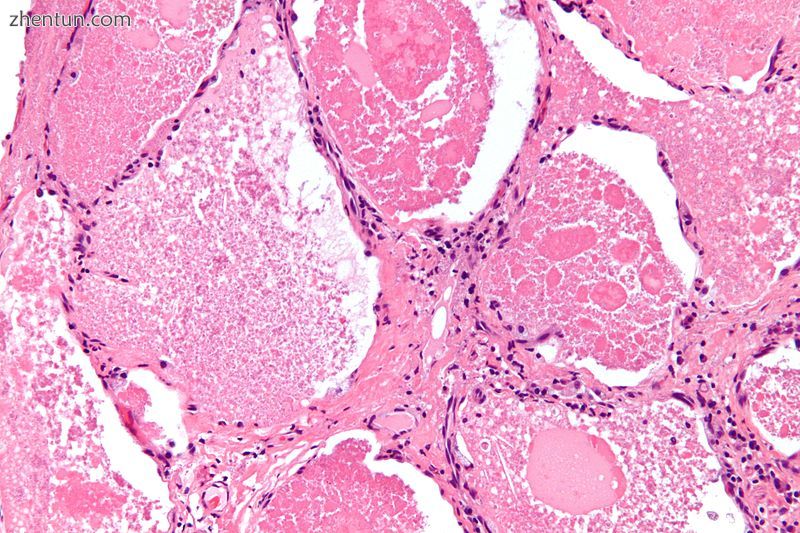 Micrograph of pulmonary alveolar proteinosis, showing the characteristic airspac.jpg